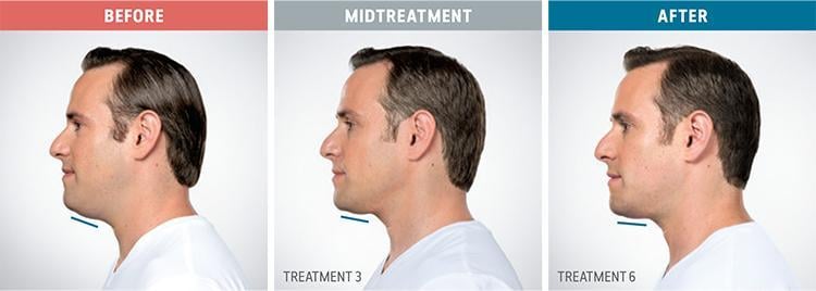 Kybella — clinical photograph published by Hudson Face & Eye