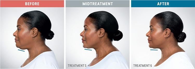 Kybella — clinical photograph published by Hudson Face & Eye