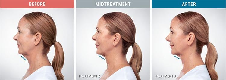 Kybella — clinical photograph published by Hudson Face & Eye