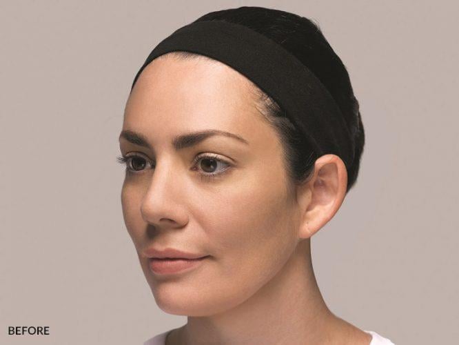 Tear Troughs — clinical photograph published by Hudson Face & Eye
