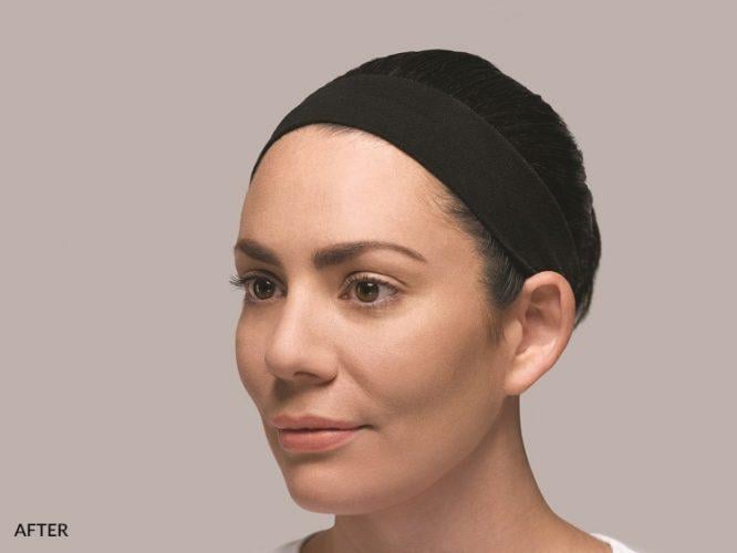 Tear Troughs — clinical photograph published by Hudson Face & Eye