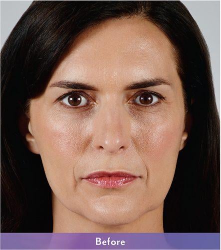 Tear Troughs — clinical photograph published by Hudson Face & Eye