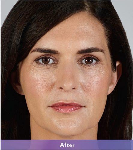 Tear Troughs — clinical photograph published by Hudson Face & Eye